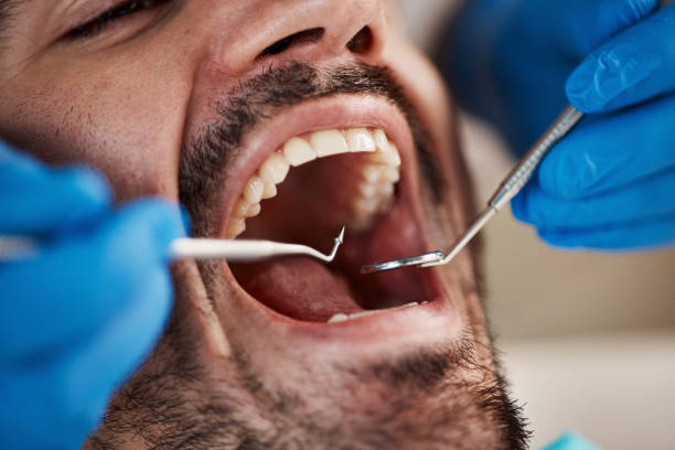 Best Emergency Dentist for Lost Fillings or Crowns in Sudan, TX